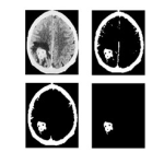 Wavelet Based Image Fusion for Brain Tumor Detection